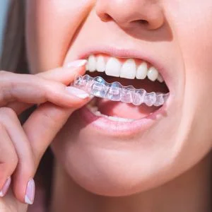 Invisalign makes orthodontic aligmnent of crooked teeth without discomfort and cost of braces.