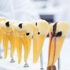 Treatment of an abcess tooth can be salvaged with endodontics and root canal.